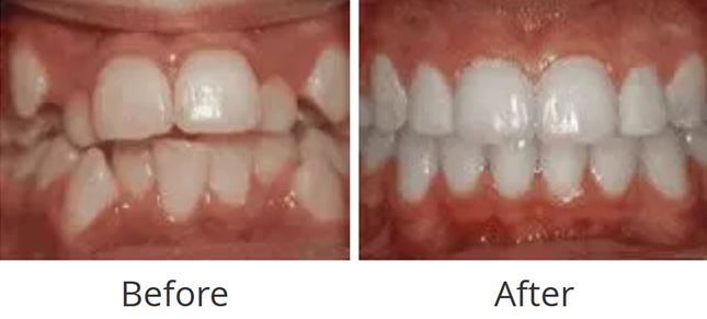 Before and after of crowded teeth corrected with orthodontic treatment