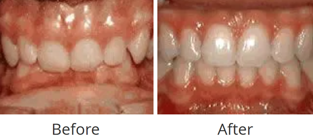 Before and after of a deep overbite where lower front teeth bit into the palate