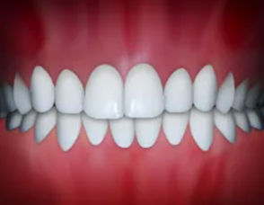 Illustration of dental midlines not matching between upper and lower teeth