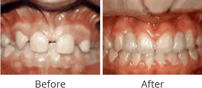 Before and after of congenitally missing lateral incisors treated with braces and bridges