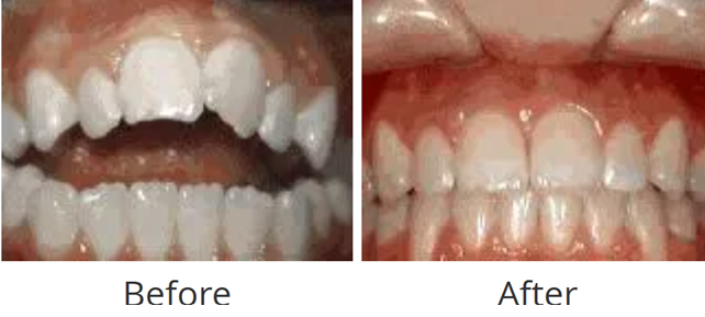 Before and after of an open bite where the front teeth didn't touch