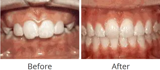 Before and after of protruding front teeth (overjet) corrected with two-phase treatment