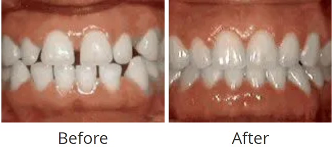 Before and after of gaps between teeth closed with braces