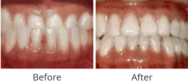 Underbite before and after, lower front teeth sitting in front of the upper teeth