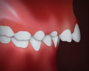 Illustration of upper front teeth protrusion