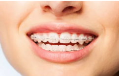 Clear ceramic braces blending with natural tooth color