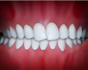 Illustration of a crossbite, upper teeth sitting inside the lower teeth