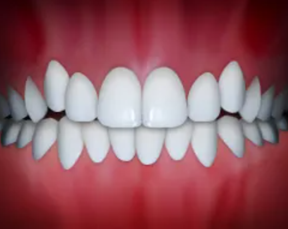 Illustration of dental crowding, teeth without enough room
