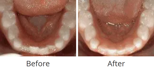 Before and after of tooth alignment improved without braces