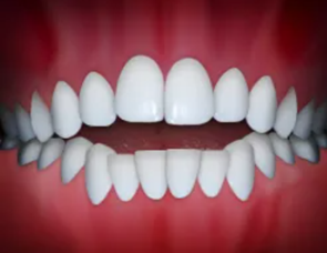 Illustration of an open bite, front teeth not overlapping