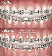 Maintaining oral hygiene during orthodontic treatment