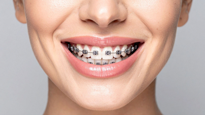 Traditional metal braces on a smiling patient