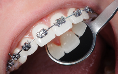 Patient smiling with braces at Brieden Orthodontics