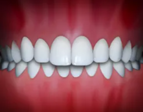 Illustration of an overbite, upper front teeth extending over the lower teeth