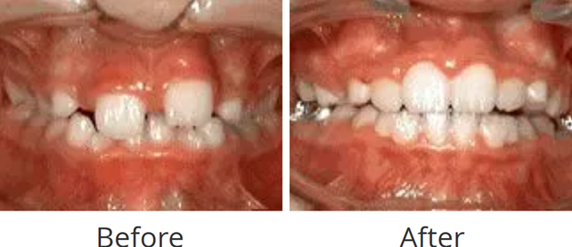 Before and after of Phase One early orthodontic treatment
