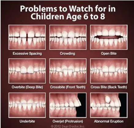 Illustrated examples of orthodontic problems to watch for in children ages 6 through 8