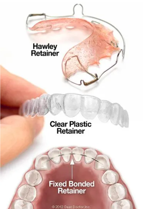 Custom orthodontic retainer from Brieden Orthodontics