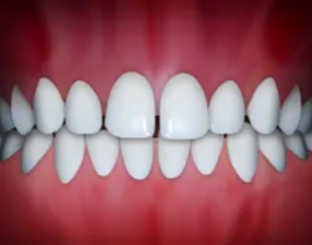 Illustration of spacing, gaps between teeth