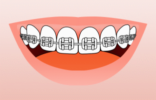 Animation showing proper brushing technique around braces brackets and wires