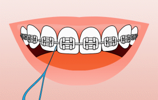 Animation showing how to floss under braces archwire with a floss threader
