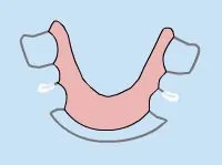 Diagram of a loose orthodontic appliance