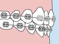 Diagram of a loose bracket on a tooth