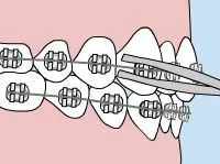 Diagram of a loose archwire slipping out of a bracket