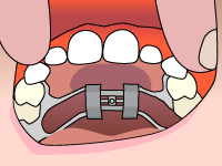 Animation of step 1: tipping the patient's head back in a well-lit area