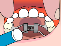 Animation of step 2: placing the key firmly into the expander hole