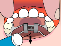Animation of step 4: pressing back and down toward the tongue to remove the key
