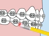 Diagram of a braces wire poking the cheek